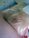Hailies head wound after another ER visit