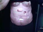 What I looked like the day after Gall Bladder Surgury