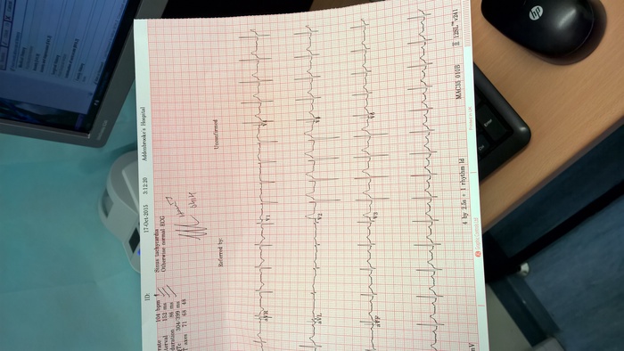 MY RESTING ECG WHEN I HAD A FEVER