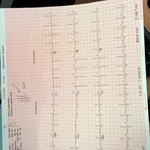 MY RESTING ECG WHEN I HAD A FEVER