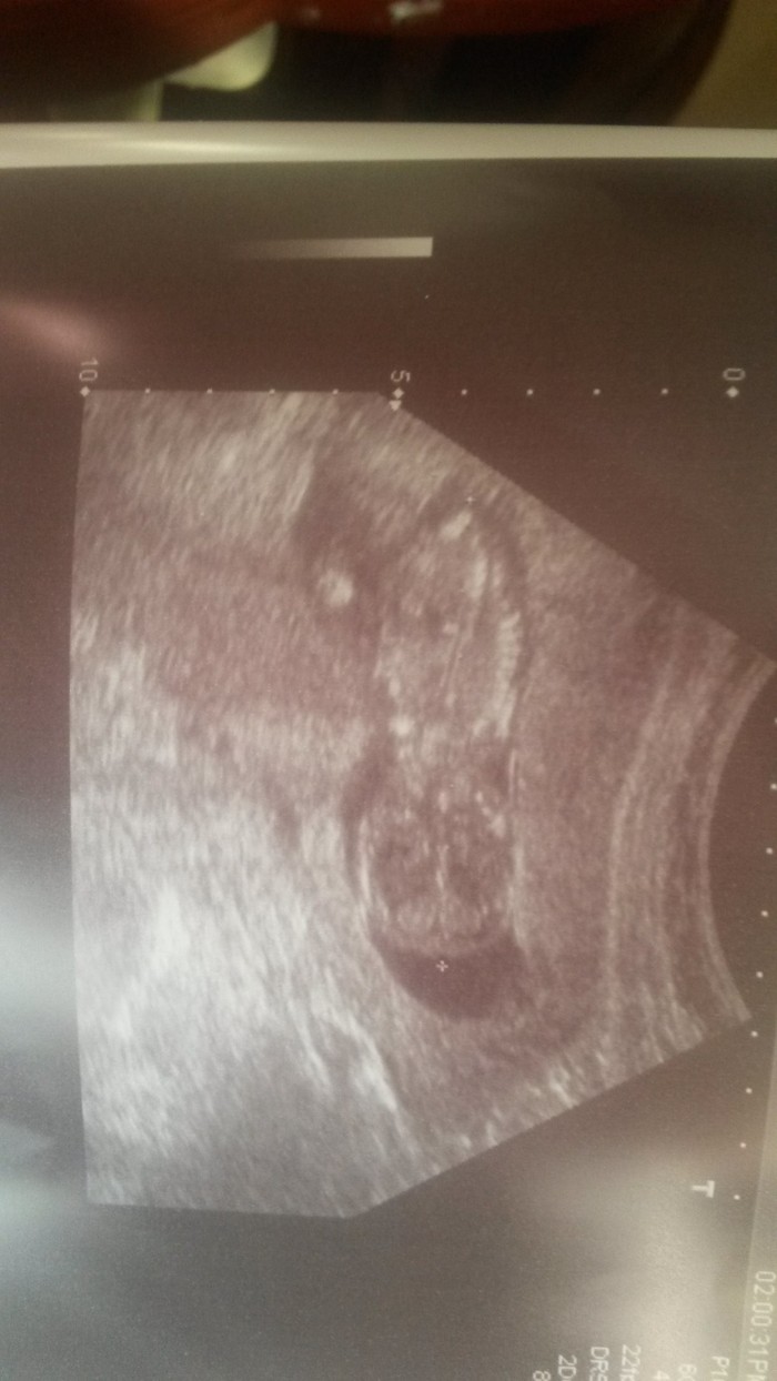 13w3d baby is perfect