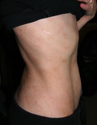 pigmentation & "sores" on torso