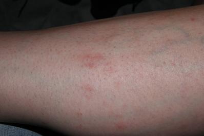 close up, rash on leg
