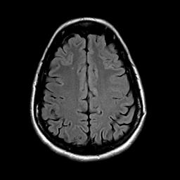 The radiologist reported "a few juxtacortical white matter lesions."