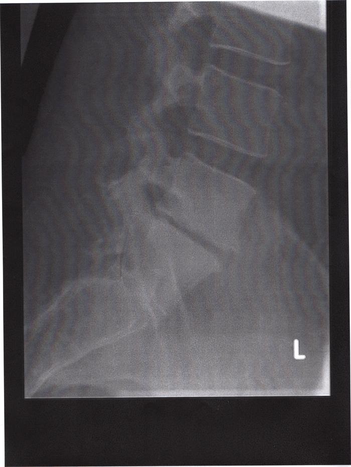 my X-Ray