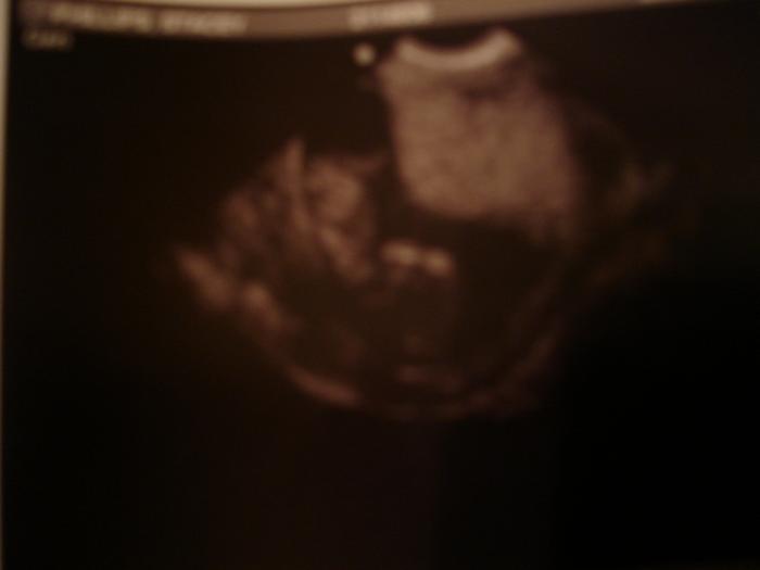 The baby is up-side-down in this one head on the bottom middle and the body is to the left.