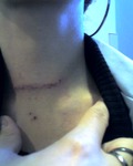 stitches out..