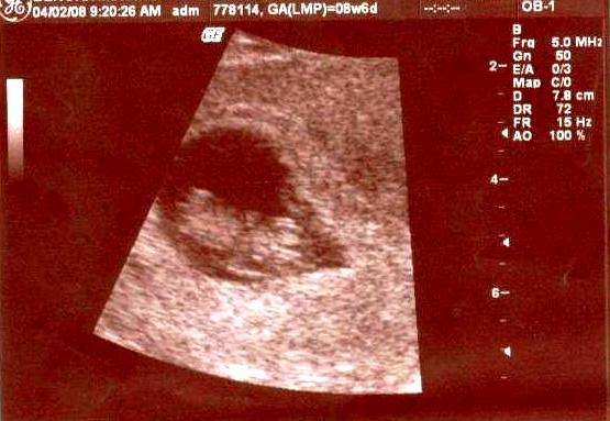 Baby Bean pic #2 8 weeks 6 days