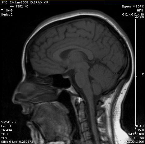 MRI - and autism...  (PDD-NOS)
