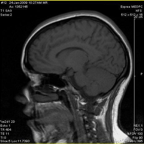 MRI - dysautonomia...