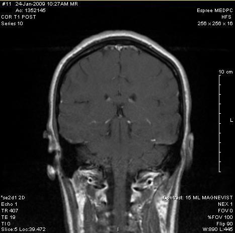 MRI - new seizures...