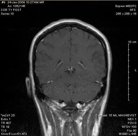 MRI - multiple head injuries, and new severe headache.