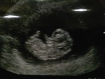 Babynut at 9.5 weeks!!