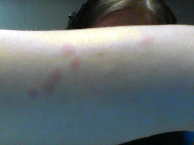 Some of the hives/rash