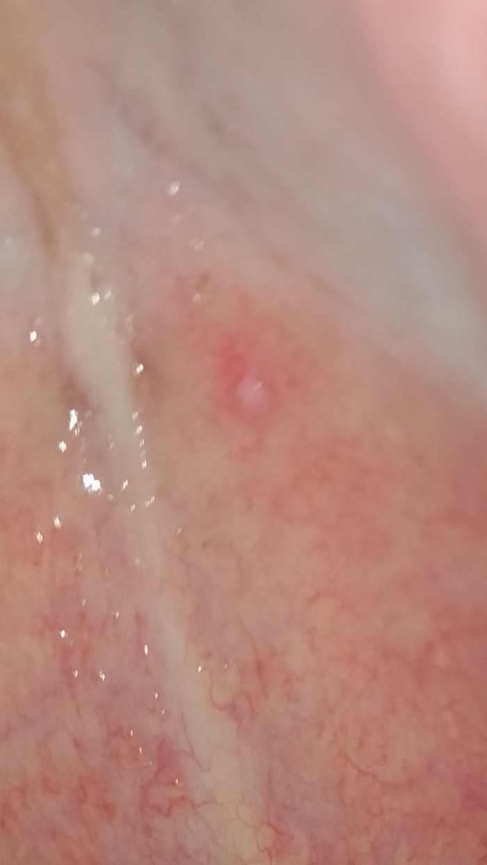 Is this hpv?
