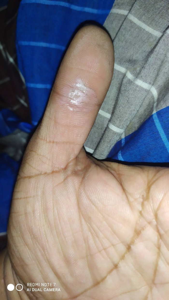 Skin hard finger line