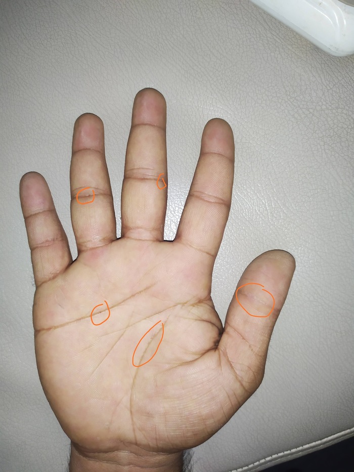 Tinny hole, fist side of start disease