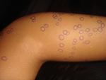 the huge white spot if a mark from tinea corporis