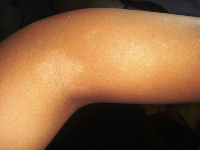 u see the huge white spot? its cause of the tinea corporis actually