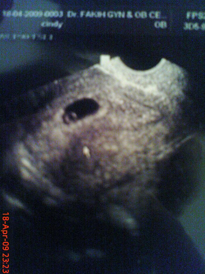 5 weeks plus ultrasound