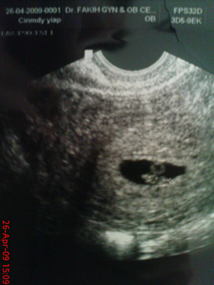 6 weeks and 5 days ultrasound