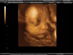 29 Weeks 3D Ultrasound