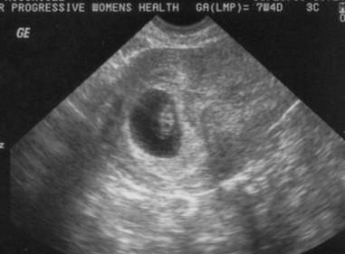 first ultrasound - 7w 5days pregnant .. i must have ovulated a little earlier