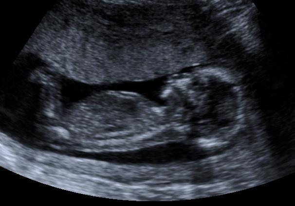Ultrasound 6-19 - 14weeks