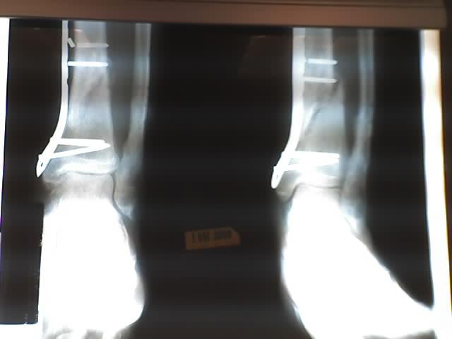 Early x-ray of fracture