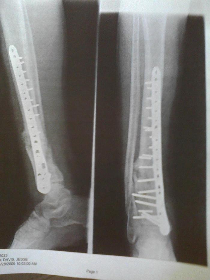 X-Ray after bone graft and new hardware