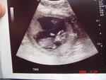 baby A 13 weeks 