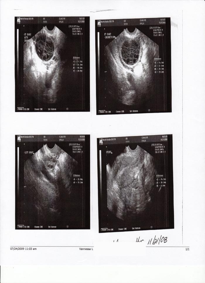 The top two are my right ovary with the cysts, the bottom left is my left ovary. 